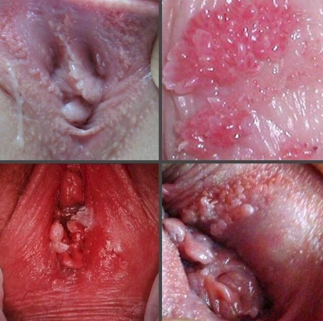 Cerca de papilomas en la vagina