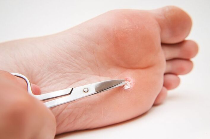cortar una verruga en la pierna