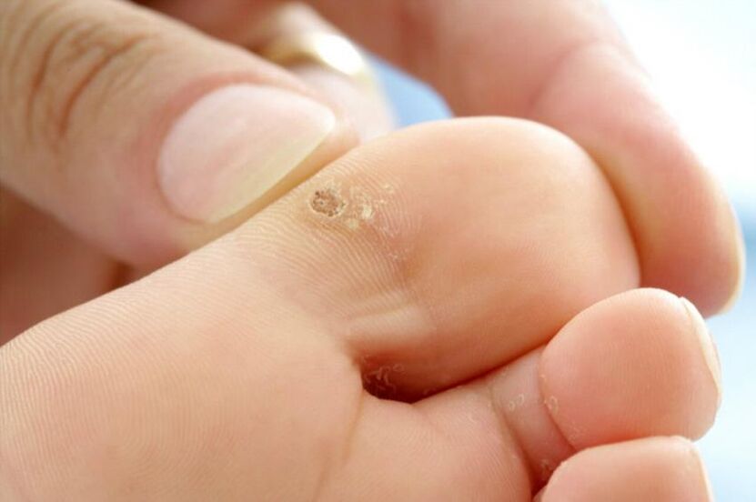 verruga en el dedo del pie