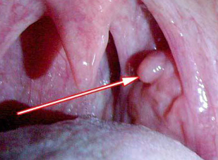 Papiloma en la laringe