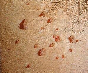 Virus del papiloma humano en la piel