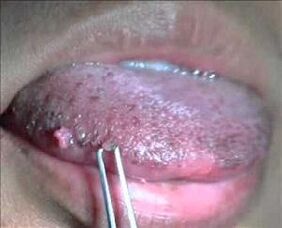 virus del papiloma humano en la lengua