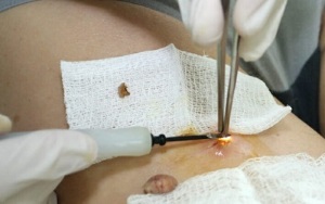 tratamiento quirúrgico del virus del papiloma humano