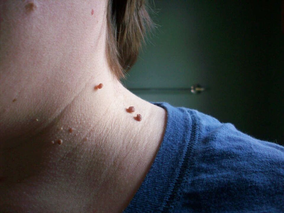 Papilomas en el cuello como tratar. 
