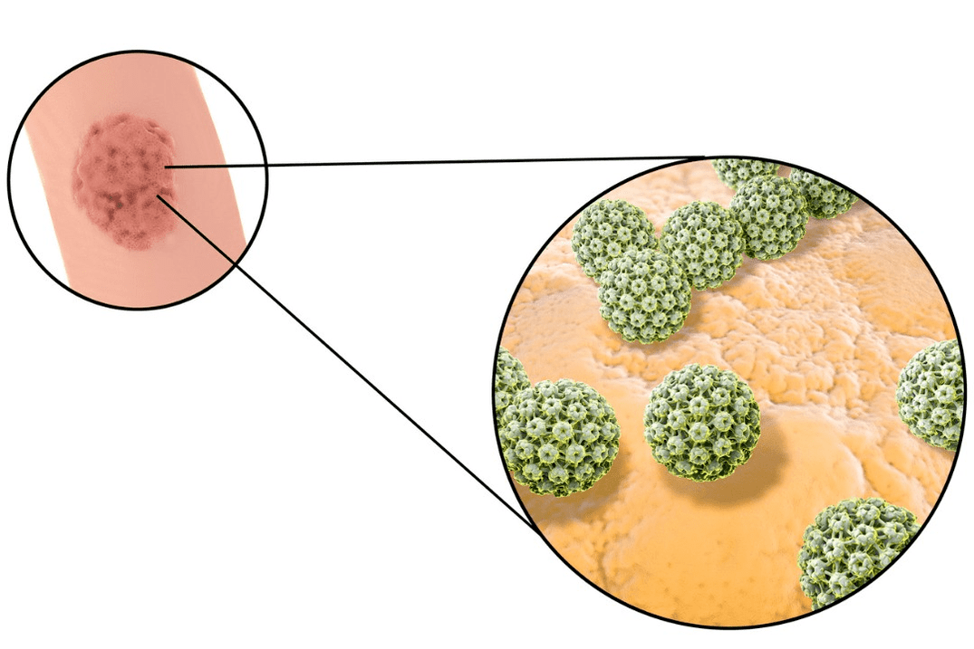 Fuente de infección por papiloma de células escamosas. 